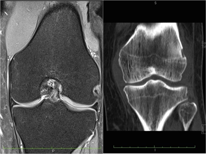 kolano MRI TK